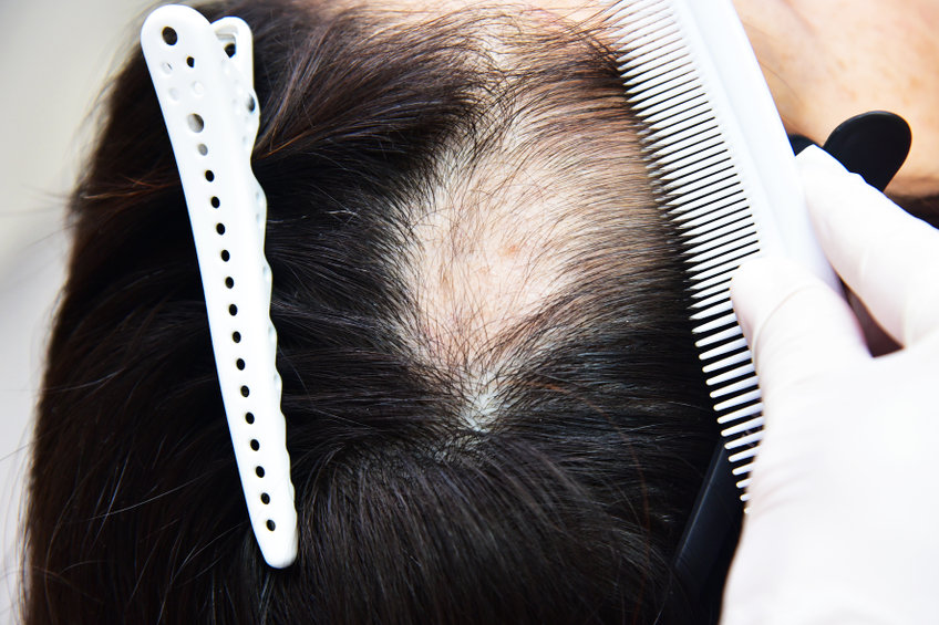 Greffe de cheveux pour homme : quelles sont les informations utiles à avoir